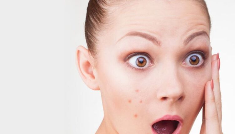 علاج الحبوب الحمراء