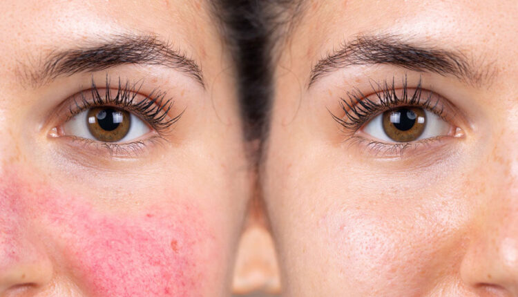 3 حلول فعالة لعلاج التهاب الجلد في المنزل