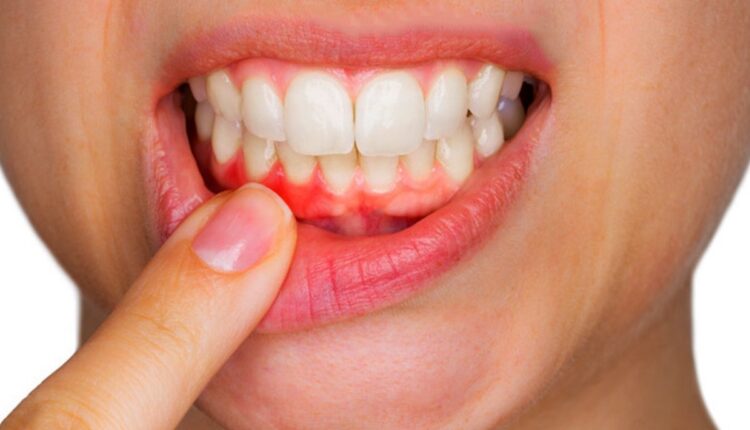 طرق علاج التهاب اللثة بدون طبيب بواسطة الوصفات في المنزل