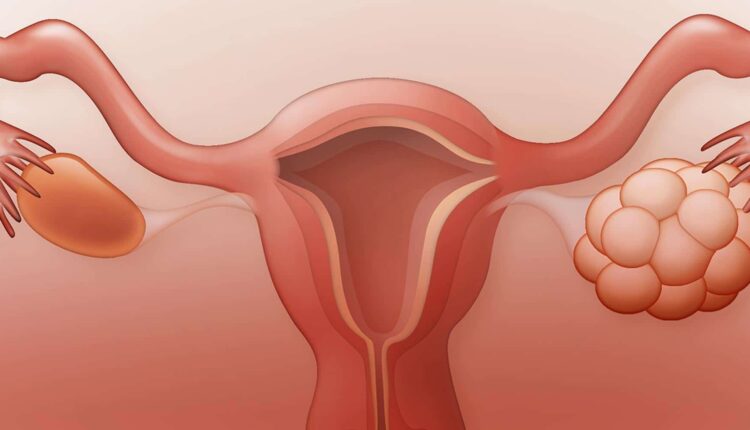 تعرفي على متلازمة تكيس المبايض.. وما هي أبرز الأعراض