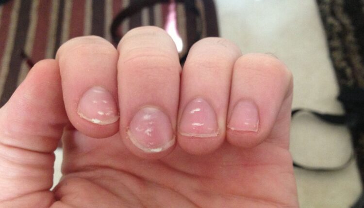 نقص فيتامين ب 12... علامات على الأظافر يمكنك اكتشافها بكل سهولة