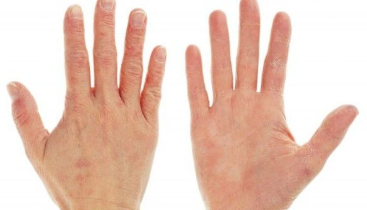 مع اقتراب الخريف.. عادات بسيطة تجنبك جفاف بشرة اليدين سريعا