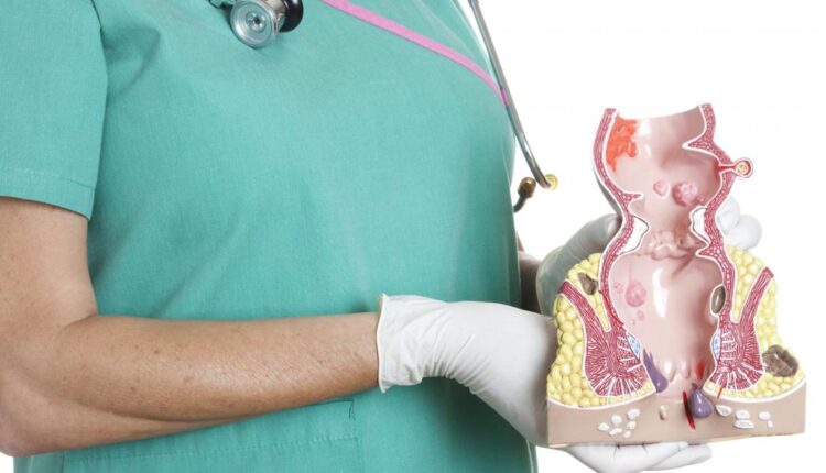 تعرف على علاج البواسير الخارجية في المنزل دون جراحة