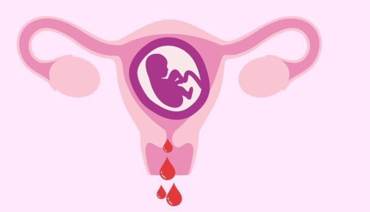 تجربتي مع نزيف الحمل بين الخوف والألم.. نصائح للتخلص من النزيف