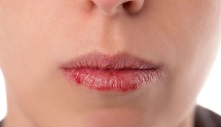أسباب خفية وراء الشفاه المتشققة في الشتاء