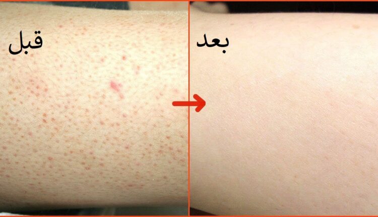 تخلصي مشكلة جلد الوزة.... بوصفات طبيعية في كل المنزل