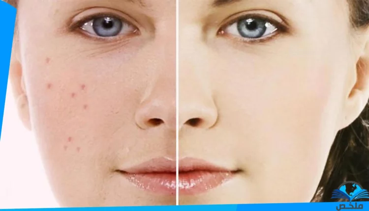 التخلص من التصبغات الجلدية بعد فصل الصيف